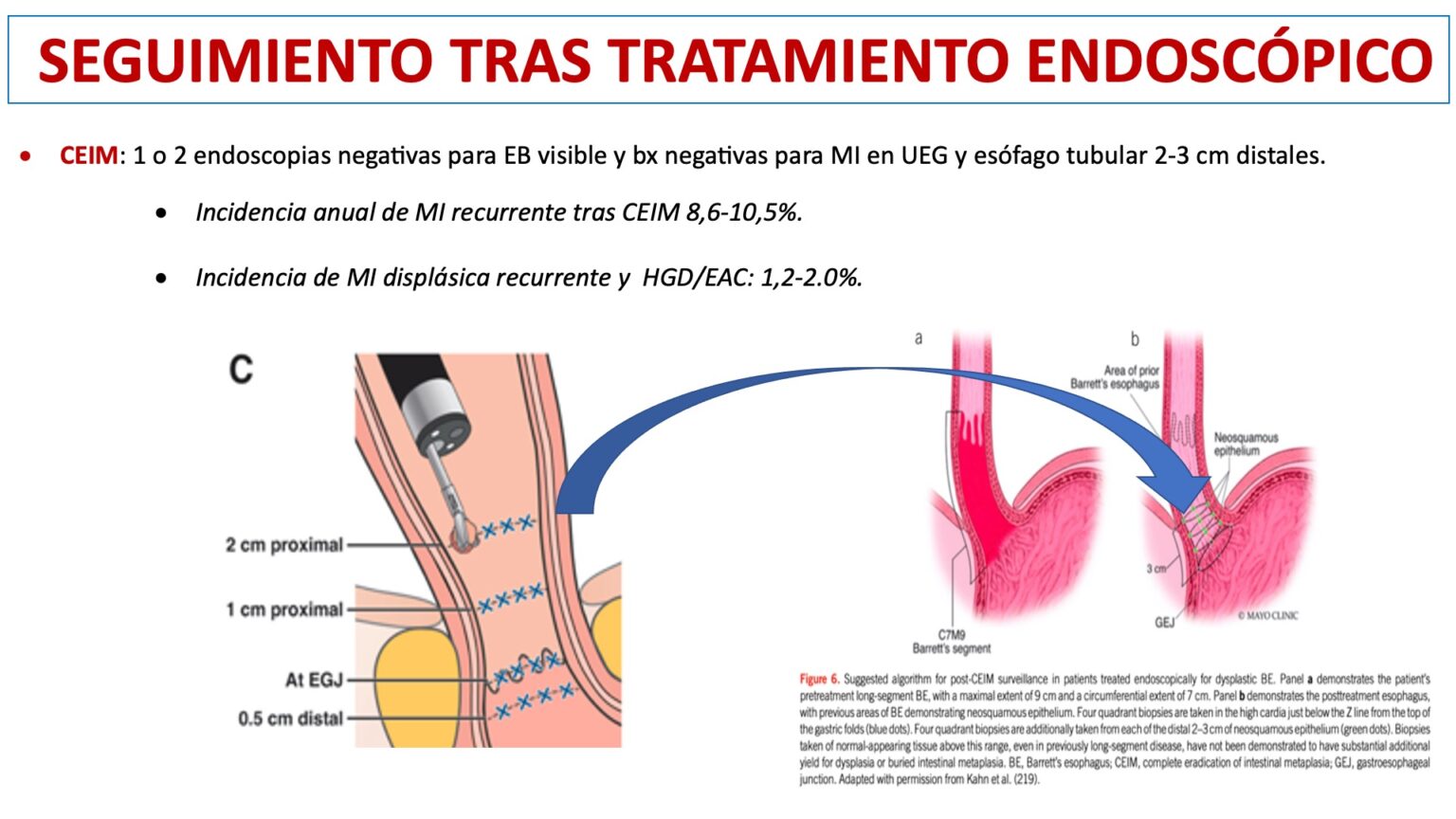 Ablación del esófago de Barrett con el sistema Hybrid APC 2